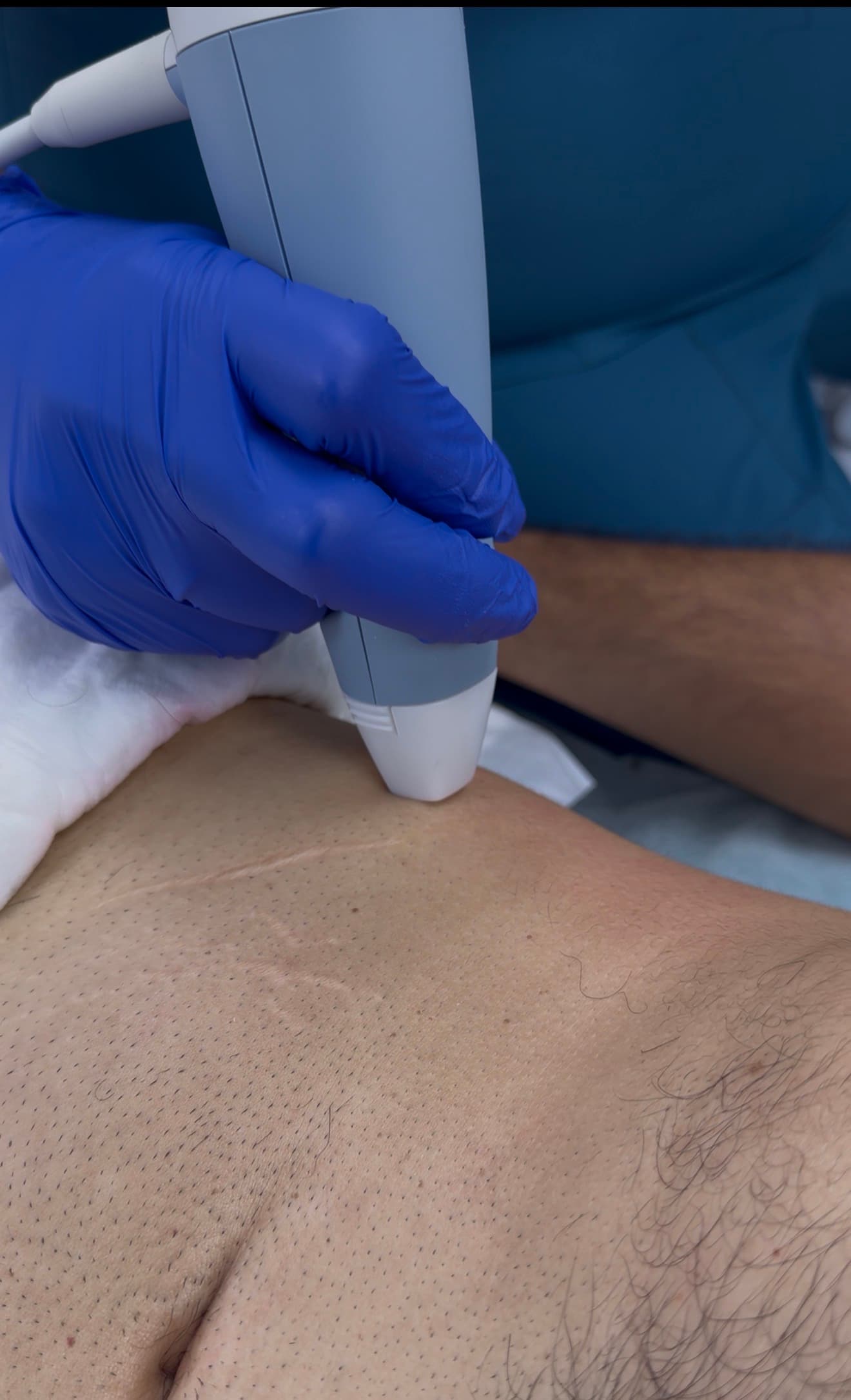 Radiofrecuencia Fraccionada Facial y Corporal EXION BTL