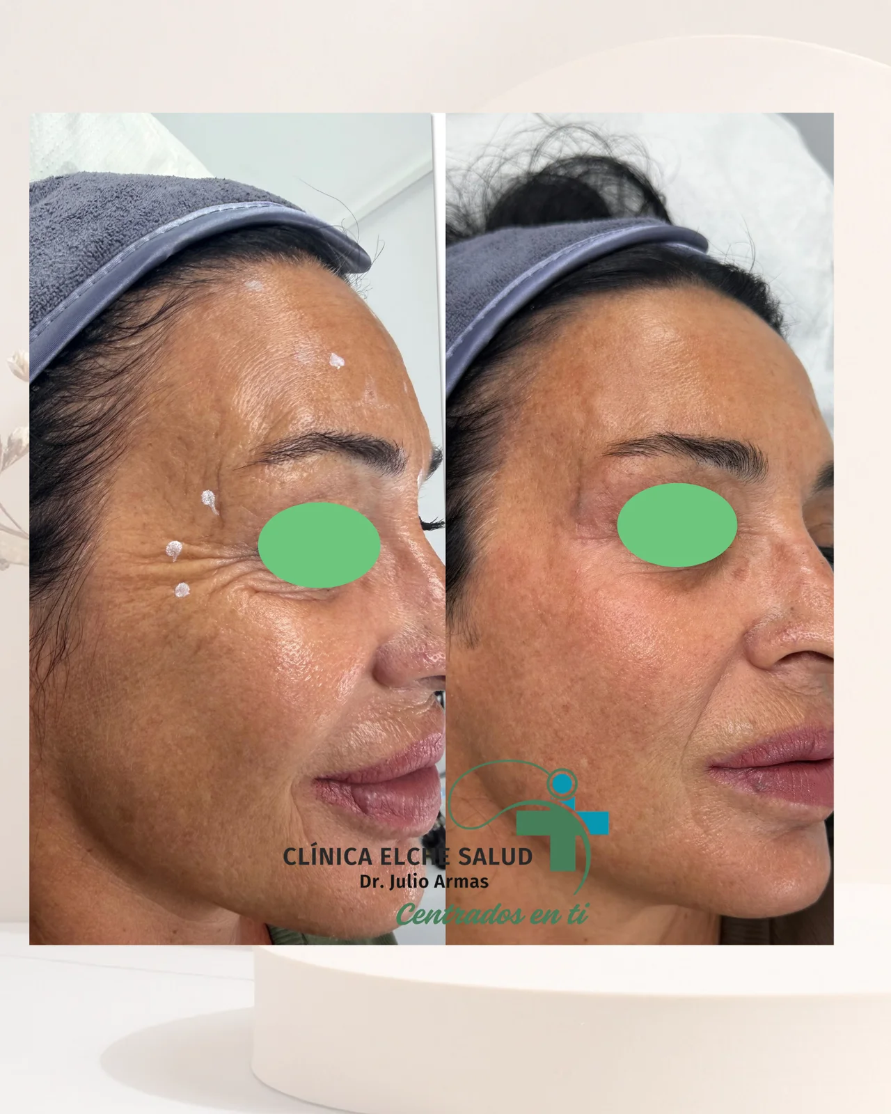 Fotografía de Tratamiento combinado con RF, HIFU, mesoterapia con vitaminas y neuromoduladores.