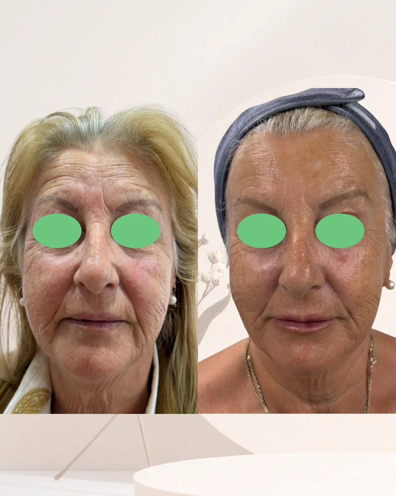 Fotografía de Rejuvenecimiento facial con protocolo combinado.