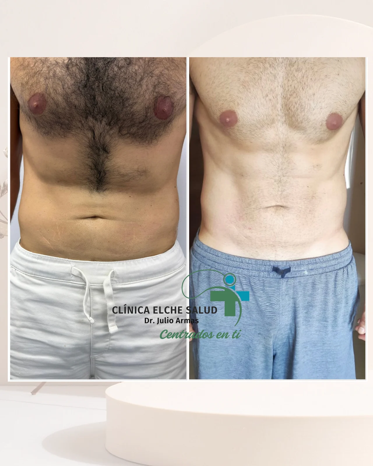 Fotografía de Tratamiento combinado RF (fraccionada con agujas), Exion (RF) y SIS (Superinductiva) en contorno.
