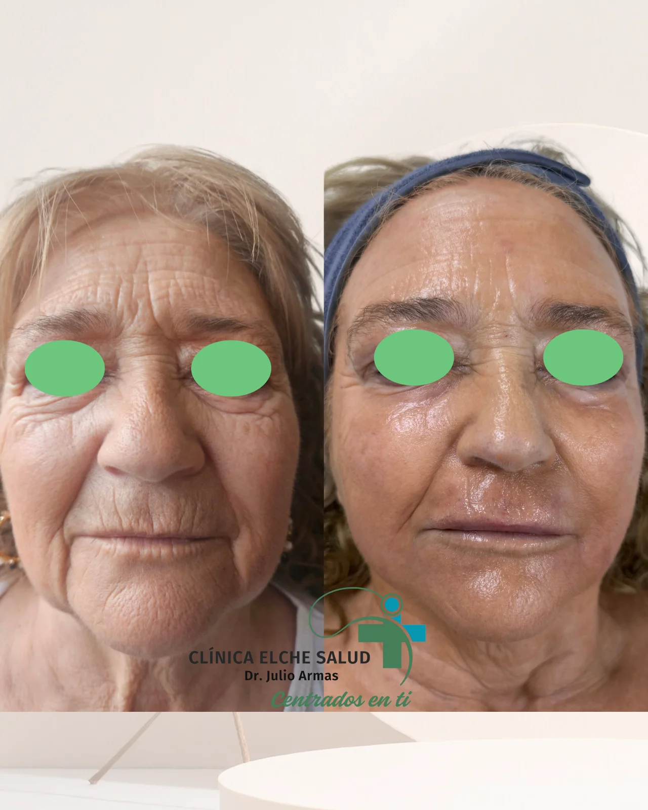 Fotografía de Resurfacing Láser CO2 + HIFU + Neuromodulador y Skinbooster.